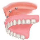 Dentures