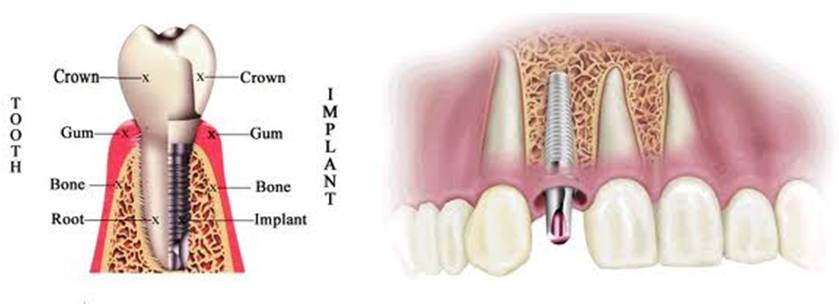 A chart that shows how dental implants can support a tooth and the entire mouth's oral health.
