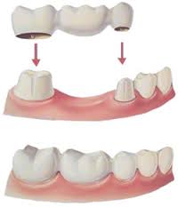 Repairing Missing Teeth