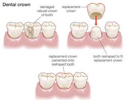 Dental Crown