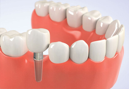 $499 Implants: Affordable Dental Implants | Southfield Family Dental - 399implant01