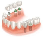 Dental Implants Livonia MI