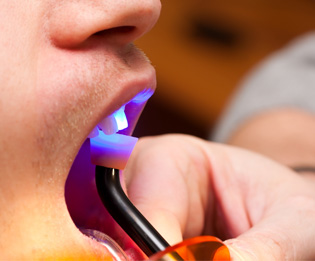 Teeth Bonding: Dental Bonding Procedures | Southfield Family Dental - bonding01