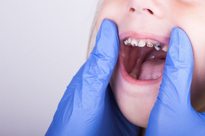 A dentist holds open a child's mouth so you can see a bad cavity.