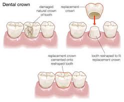 Dental Crown Farmington
