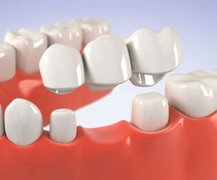 Tooth Crowns: Dental Crown Procedures | Southfield Family Dental - crown01
