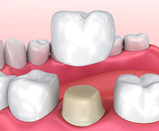 Tooth Crowns: Dental Crown Procedures | Southfield Family Dental - crwon02