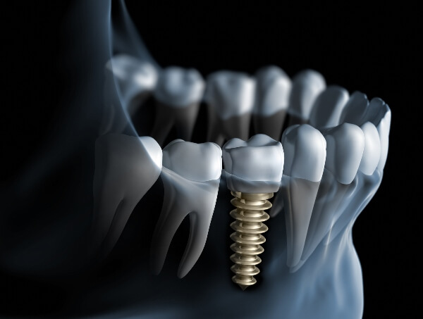 An x-ray of a mouth shows a set of teeth with a dental implant drilled into the jaw.