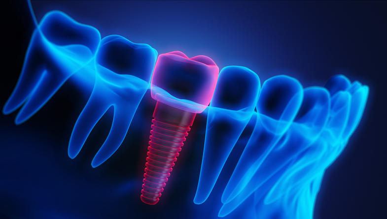 A digital x-ray of a mouth displays a dental implant - a solution to missing teeth that will last a long time if you properly care for it.