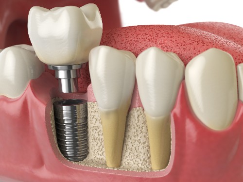 Why Dental Implants: The Benefits of Dental Implant Procedures