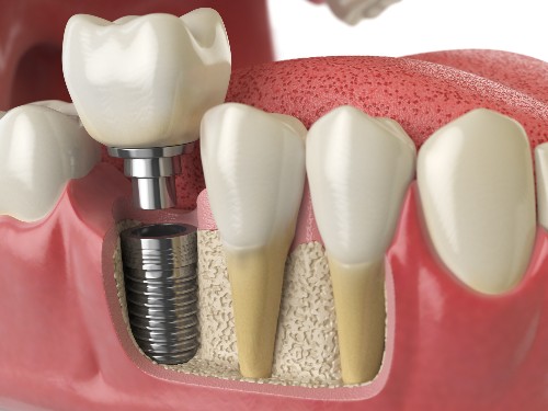 There is a display of a dental implant and where it connects to the jaw.