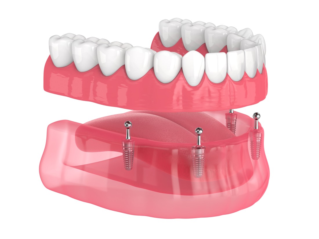 3D rendering of overdentures