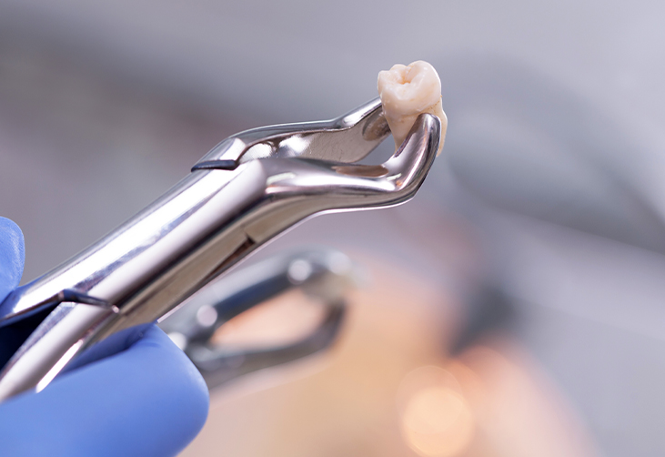 Dentist holding an extracted tooth