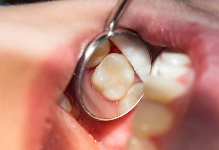 Dentist inspecting a patient's teeth