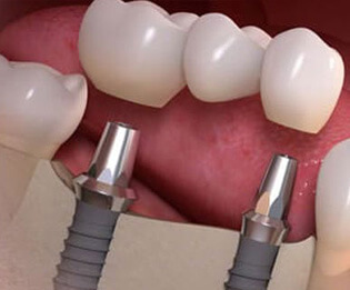 Dental Implants Michigan: $499 Implants | Southfield Family Dental - implant02