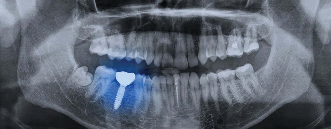 Dental Implants Michigan: $499 Implants | Southfield Family Dental - implant1