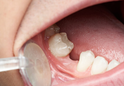 $499 Implants: Affordable Dental Implants | Southfield Family Dental - implanto03