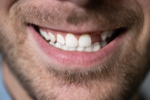 A man smiles with a straight, white set of teeth, but has a gap due to missing a tooth.