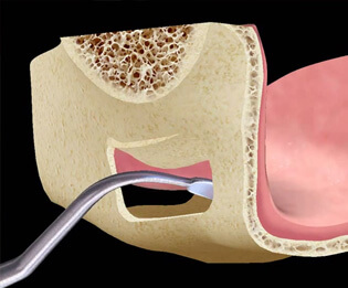 Dental Bone Graft: Dental Implants | Southfield Family Dental - sinus-lift01
