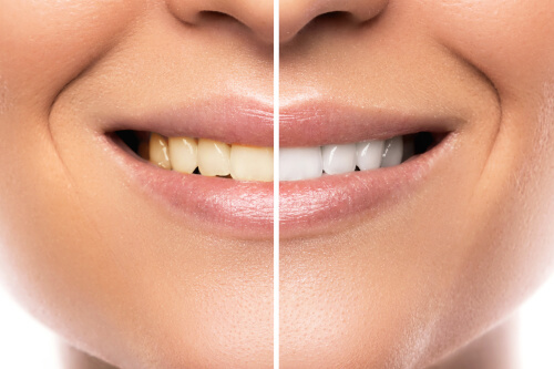 A woman smiles with a white line dividing her face in half - her right side has yellow teeth while her left side has white teeth.