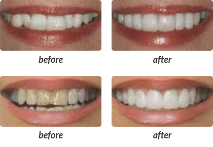 Michigan Cosmetic Dentistry: Veneers & More | Southfield Family Dental - teeth01