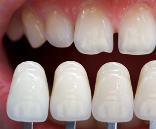 Dental Veneers: Cosmetic Dentistry | Southfield Family Dental - veneers01