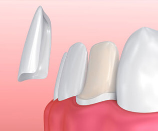 Dental Veneers: Cosmetic Dentistry | Southfield Family Dental - veneers2