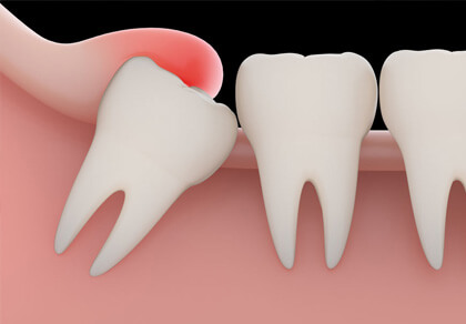 Wisdom Teeth Removal: Wisdom Teeth Extraction | Southfield Family Dental - wisdom01