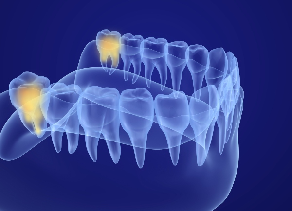 A digital display shows the wisdom teeth in the back of the lower jaw as they grow.