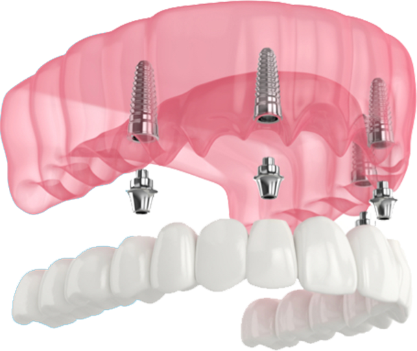 All-On-4 Implants | Southfield, MI | Southfield Dental - allon4-denchers
