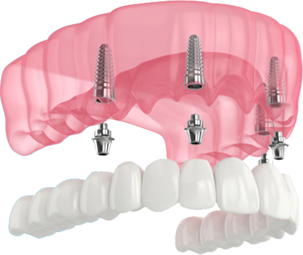 3D rendering of dental implants