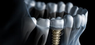 All-On-4 Implants | Southfield, MI | Southfield Dental - trad-implants